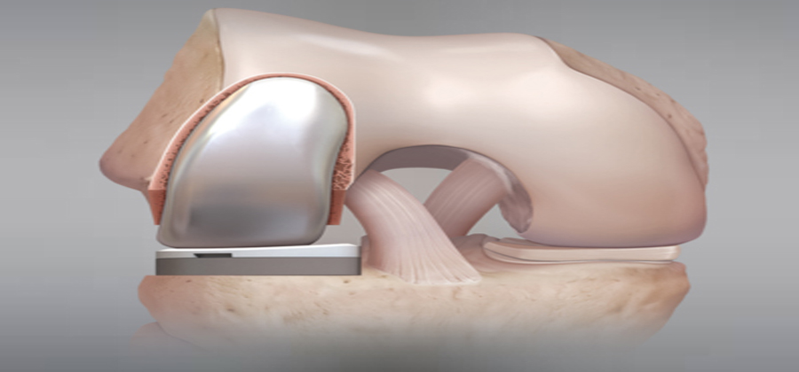ACL Surgery in Hyderabad
