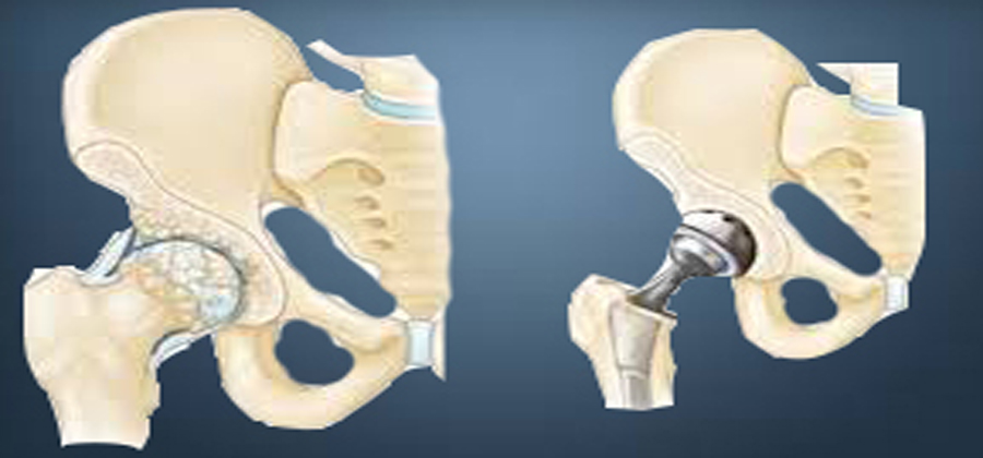 Total Hip Replacement Surgeon in Hyderabad