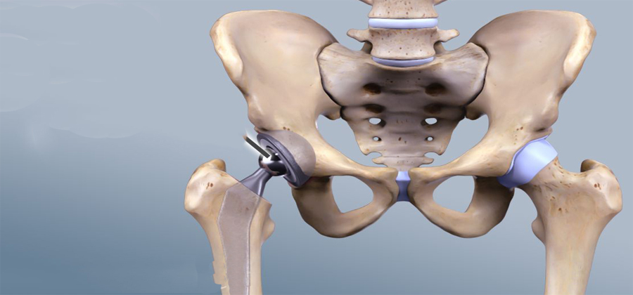 Total Hip Replacement Surgery in HYderabad