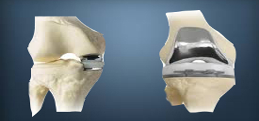 Partial Knee Replacement Surgery in HYderabad