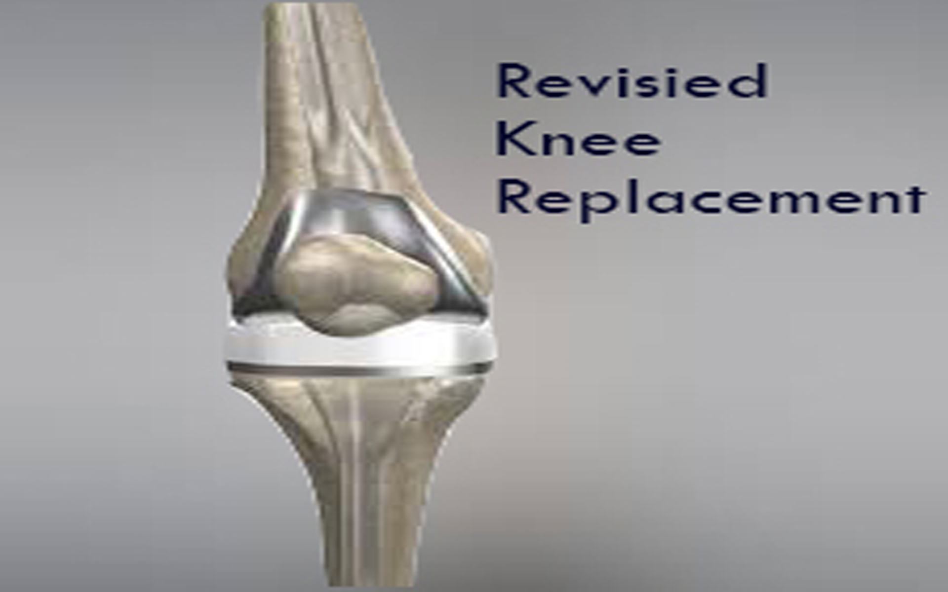 Reversed Knee Replacement Surgery